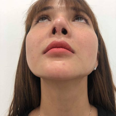 khach hang phuong binh sau khi nang mui