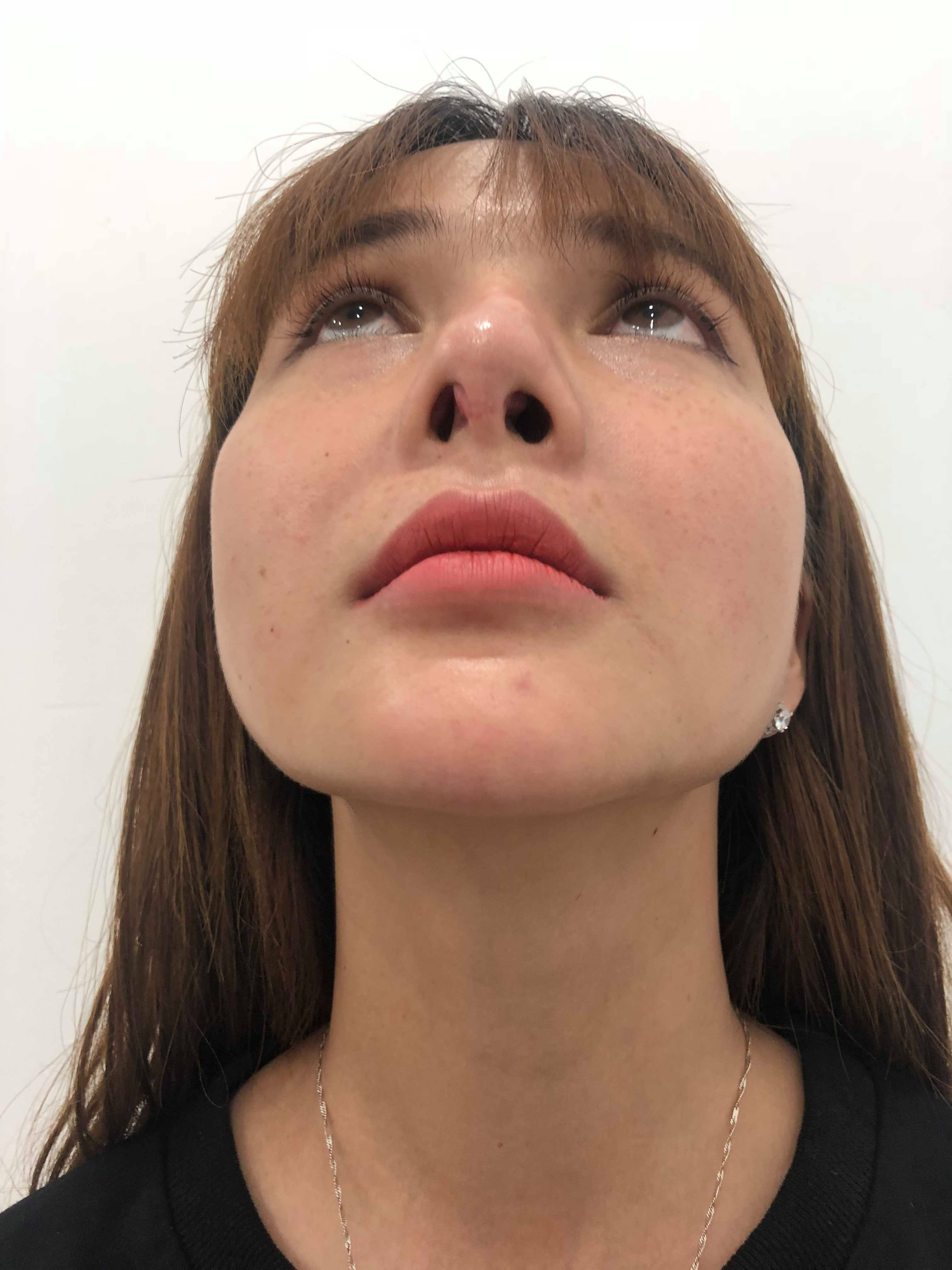 khach hang phuong binh sau khi nang mui