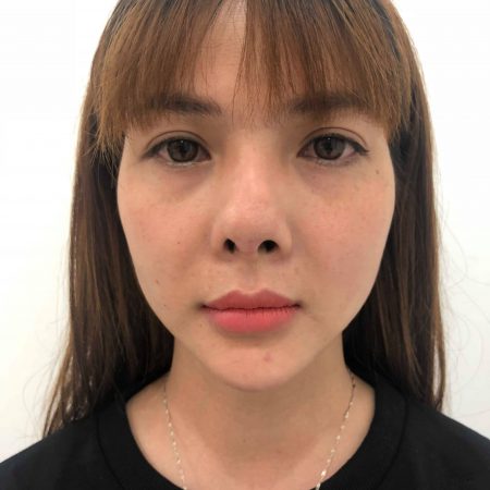 khach hang phuong binh sau khi nang mui