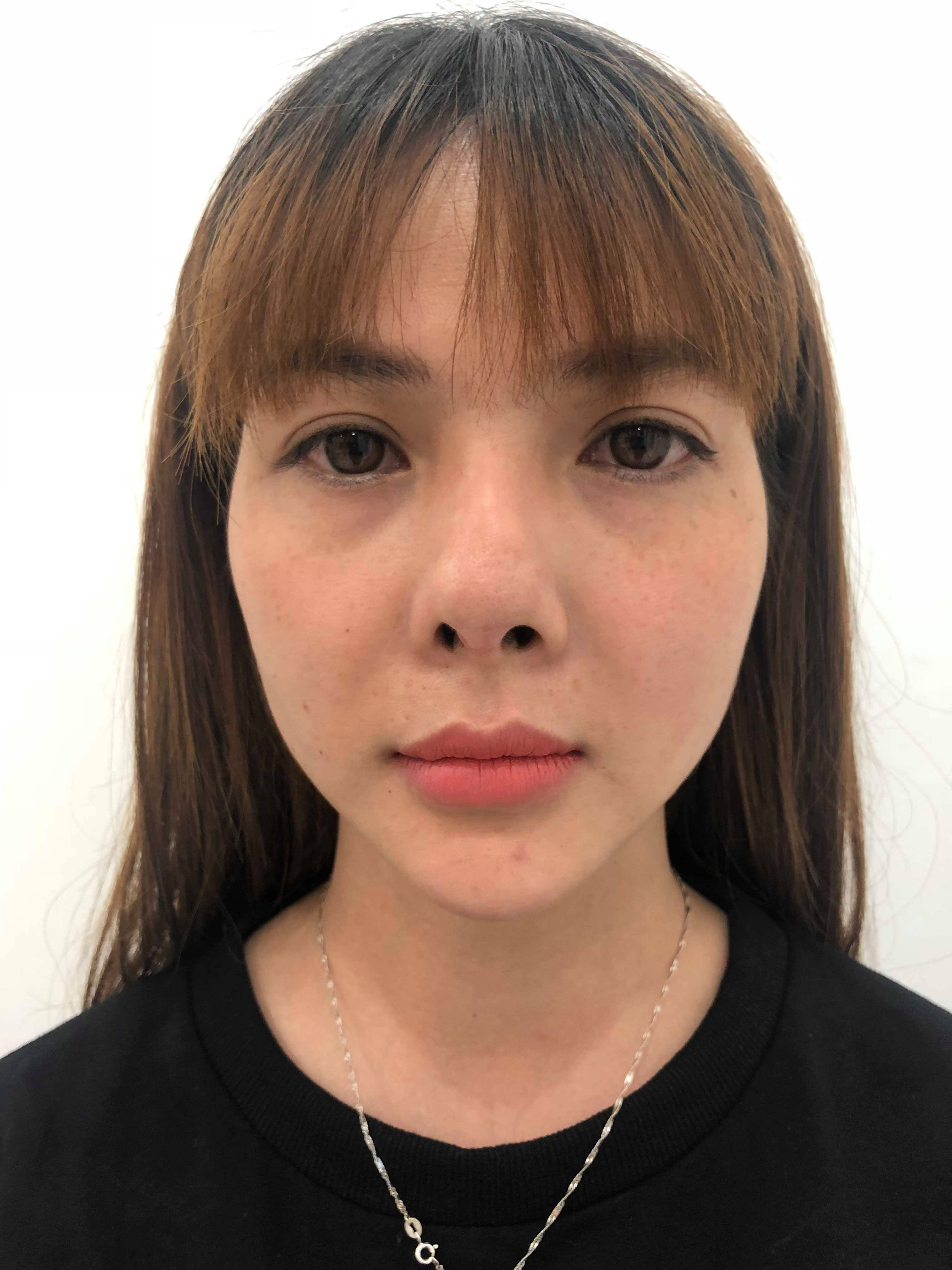 khach hang phuong binh sau khi nang mui