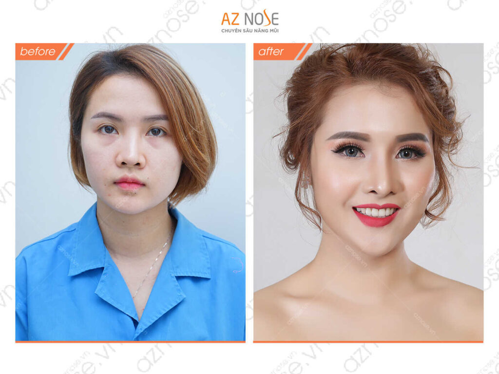 Khách hàng Tấn Tài sau 1 năm sửa mũi lệch.