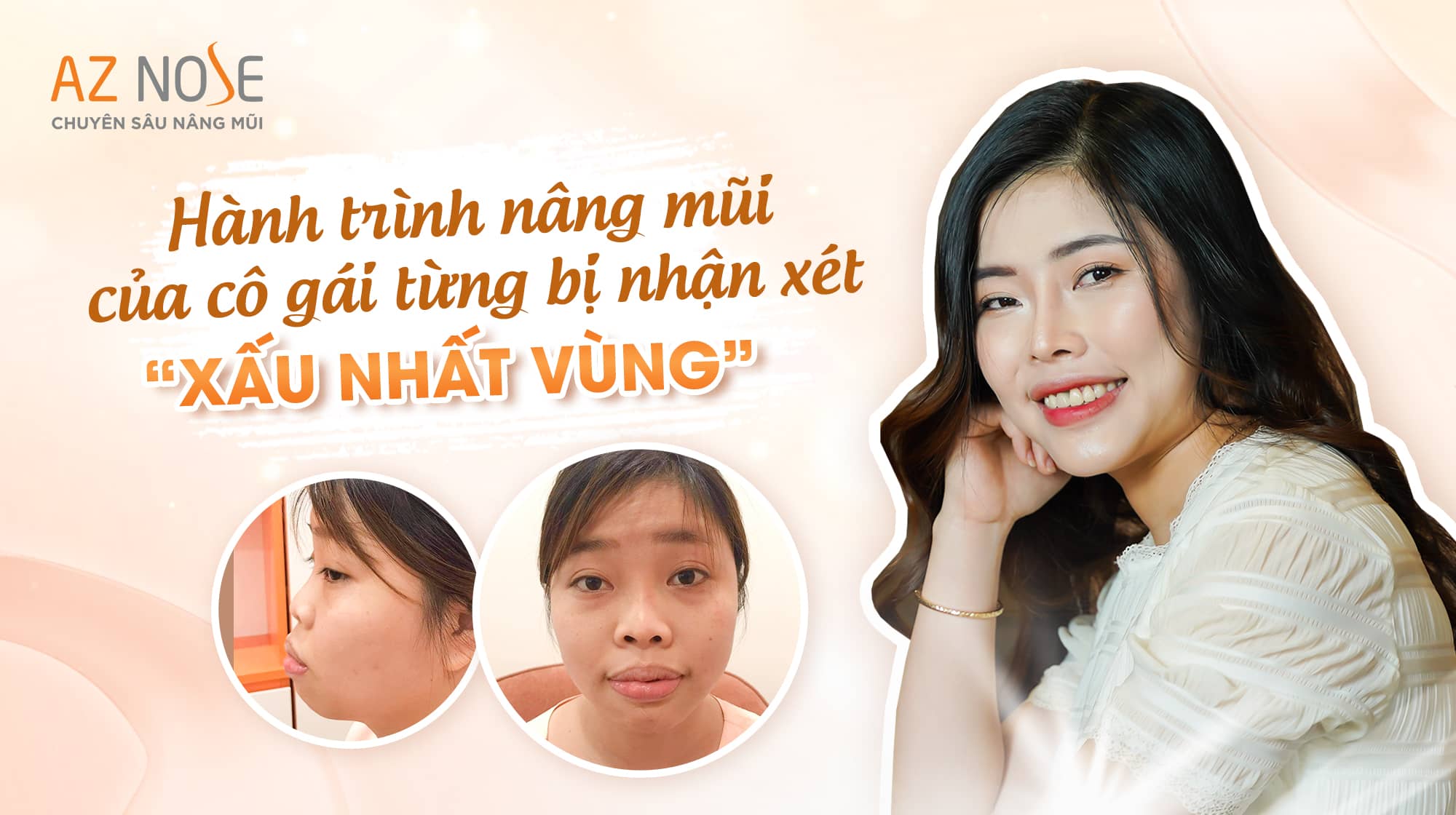Từ cô gái bị nhận xét “xấu nhất vùng”, mình đã thay đổi như thế nào sau nâng mũi tại AZ NOSE?